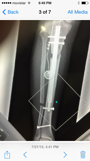 X Ray Post Op 14 days